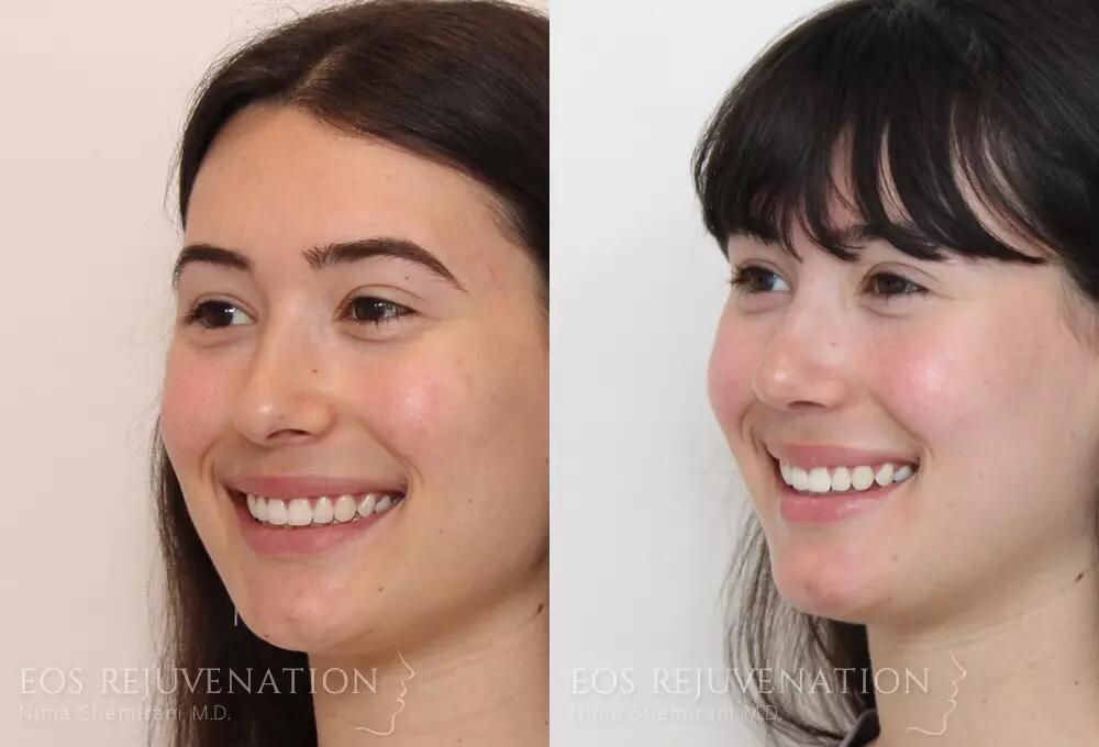 Rhinoplasty Before & After