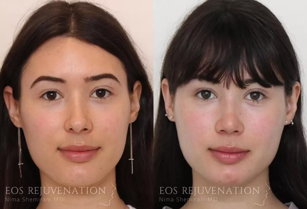 Rhinoplasty Before & After