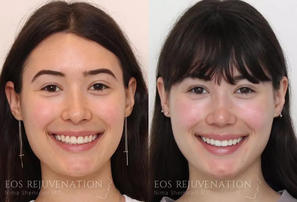 Rhinoplasty Before & After