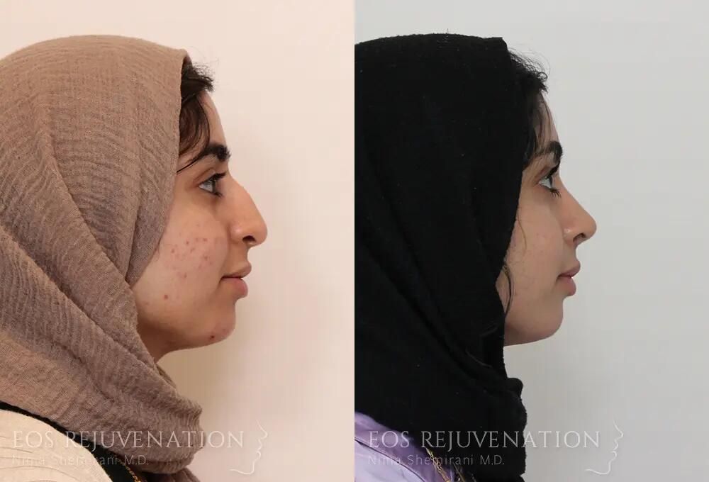 Rhinoplasty Before & After