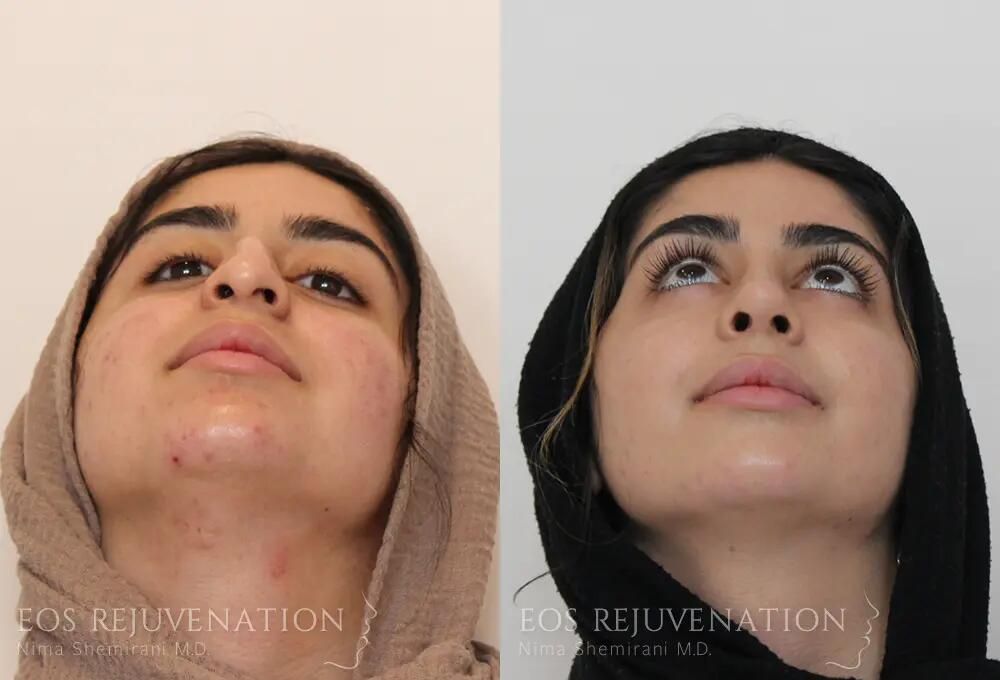 Rhinoplasty Before & After