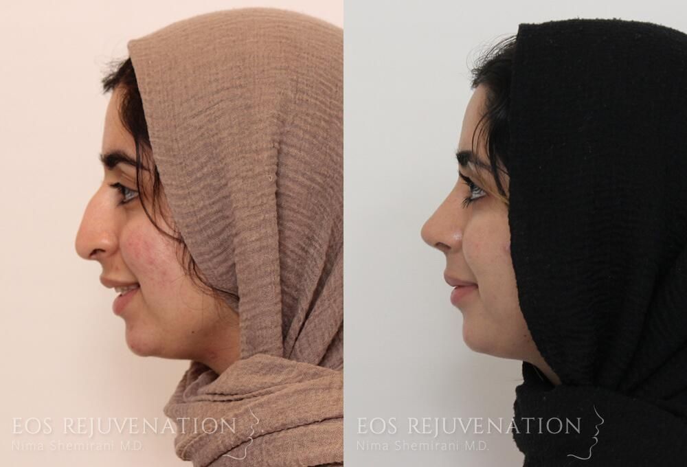 Rhinoplasty Before & After