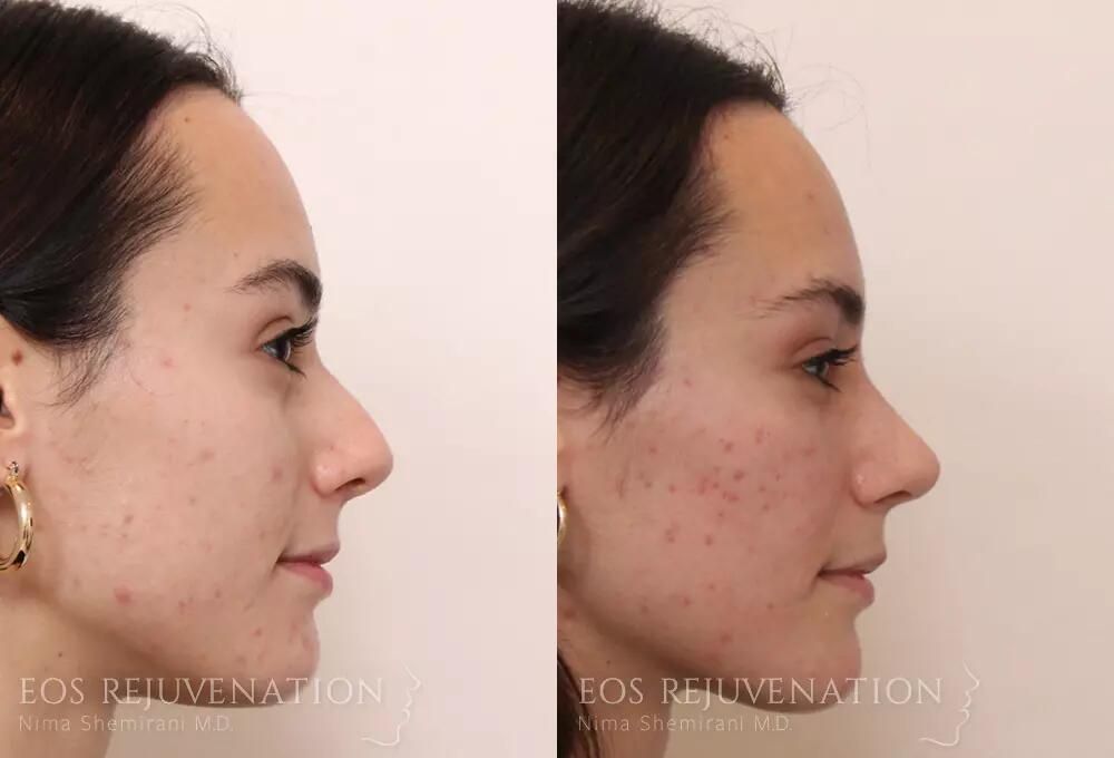 Rhinoplasty Before & After