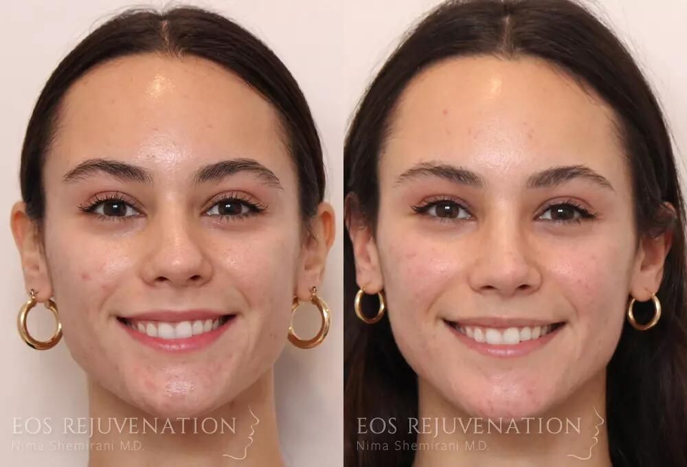 Rhinoplasty Before & After