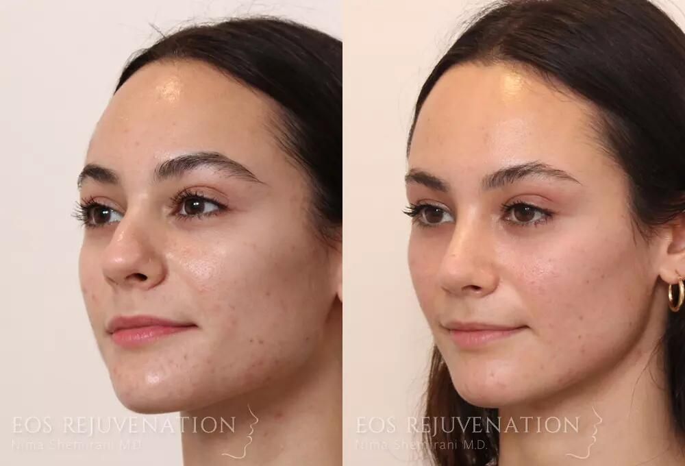 Rhinoplasty Before & After