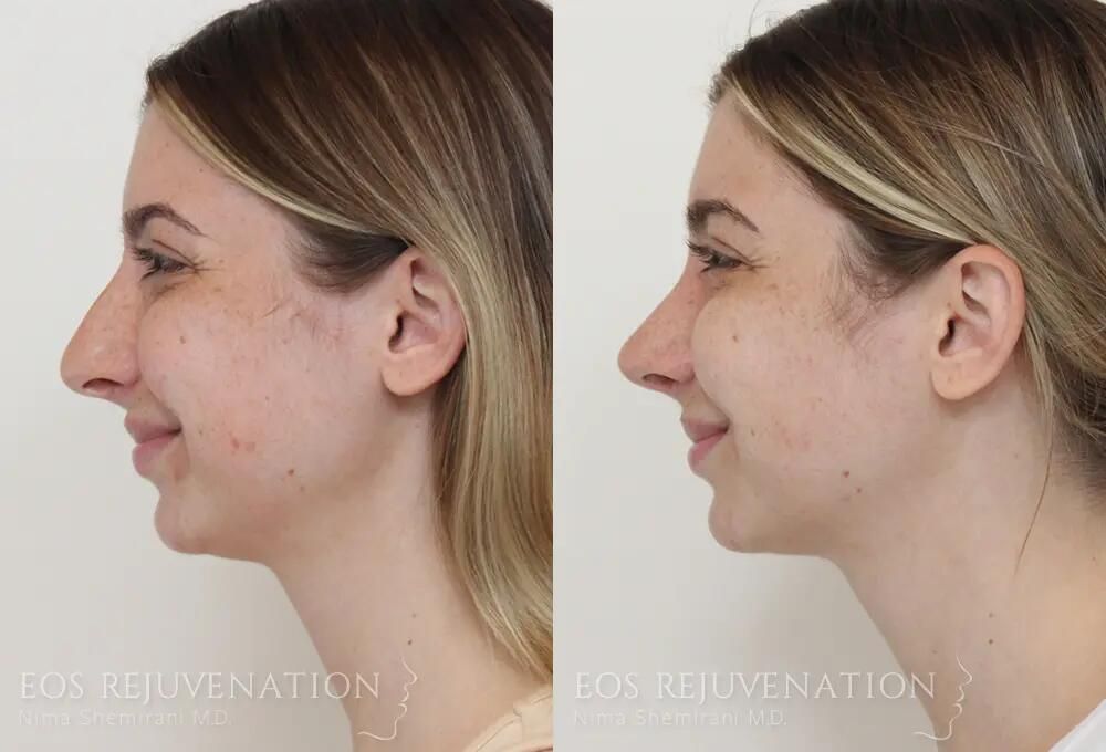 Rhinoplasty Before & After