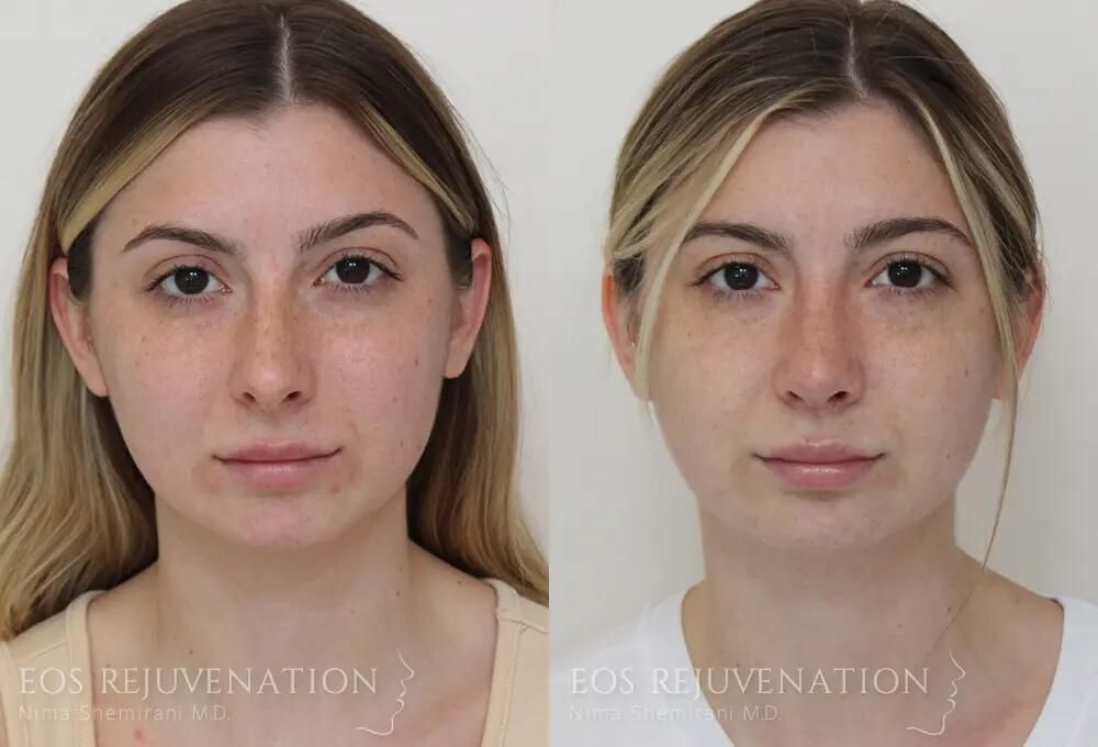 Rhinoplasty Before & After
