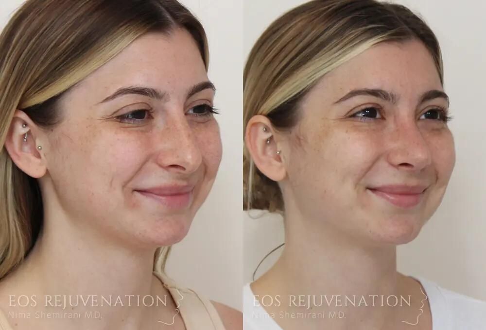 Rhinoplasty Before & After