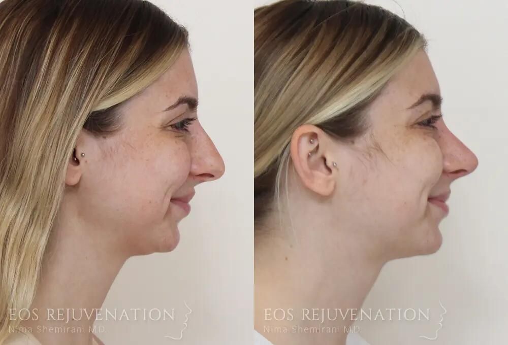Rhinoplasty Before & After