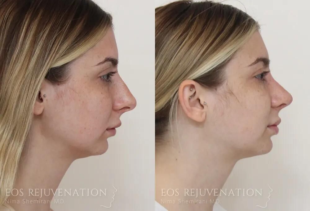 Rhinoplasty Before & After