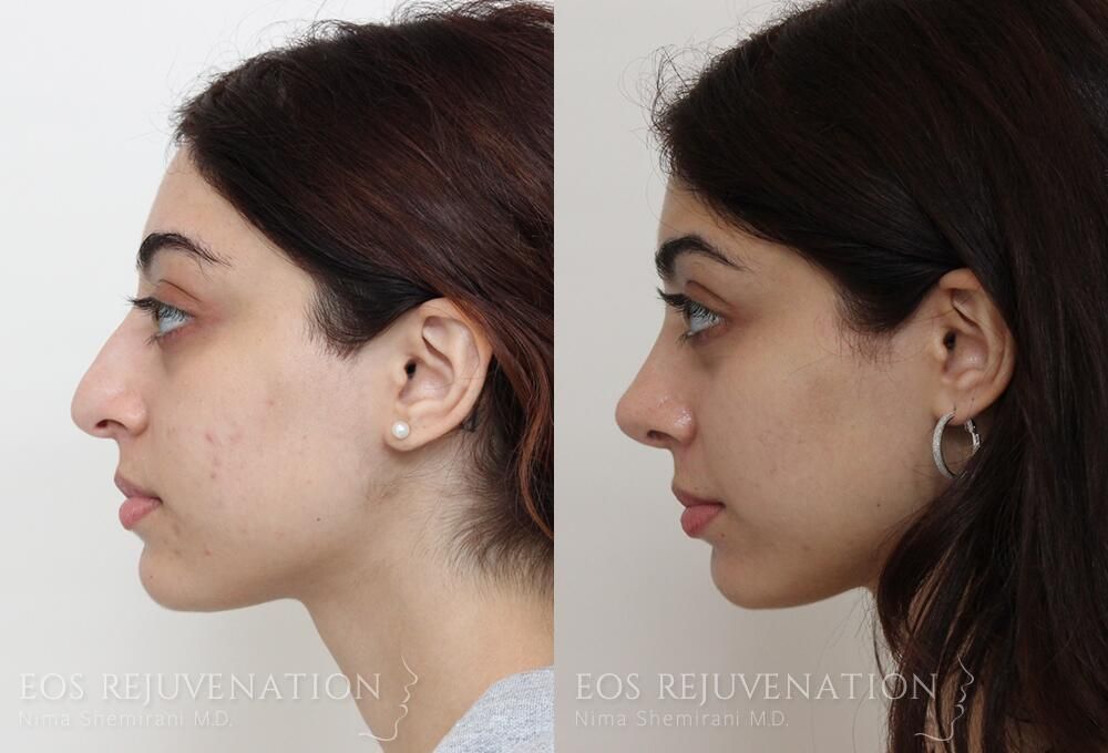 Rhinoplasty Before & After
