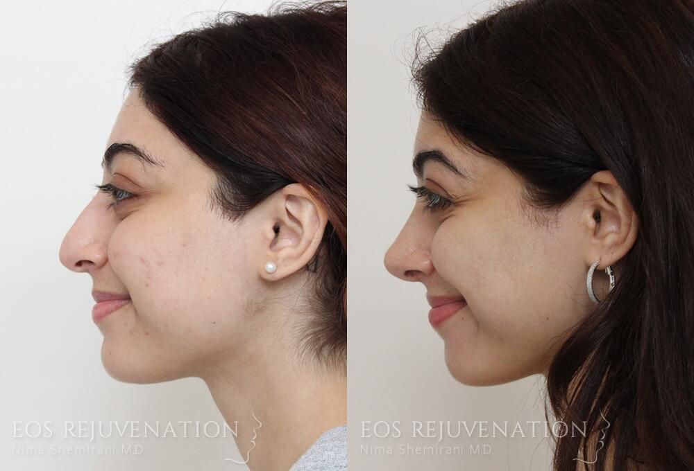 Rhinoplasty Before & After