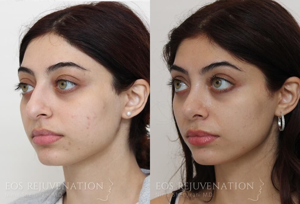 Rhinoplasty Before & After