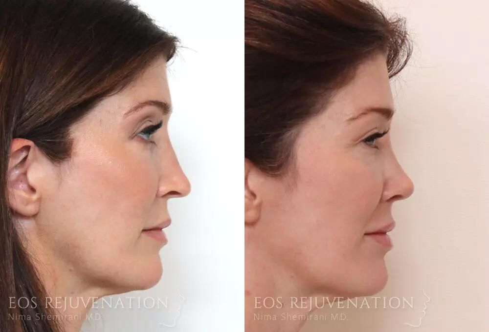 Rhinoplasty Before & After