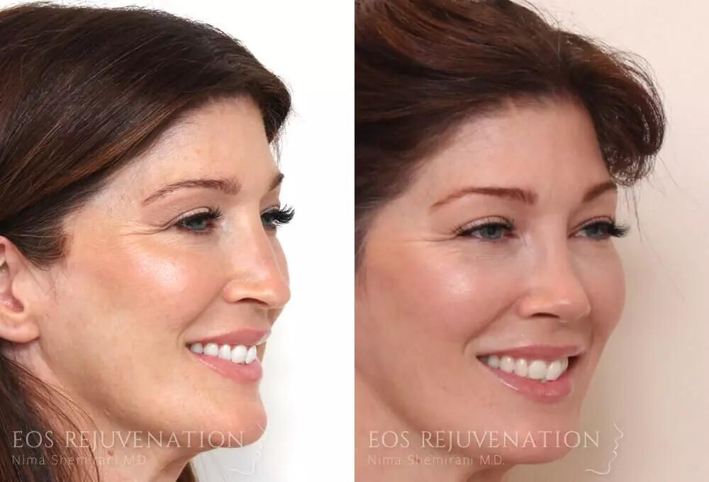 Rhinoplasty Before & After