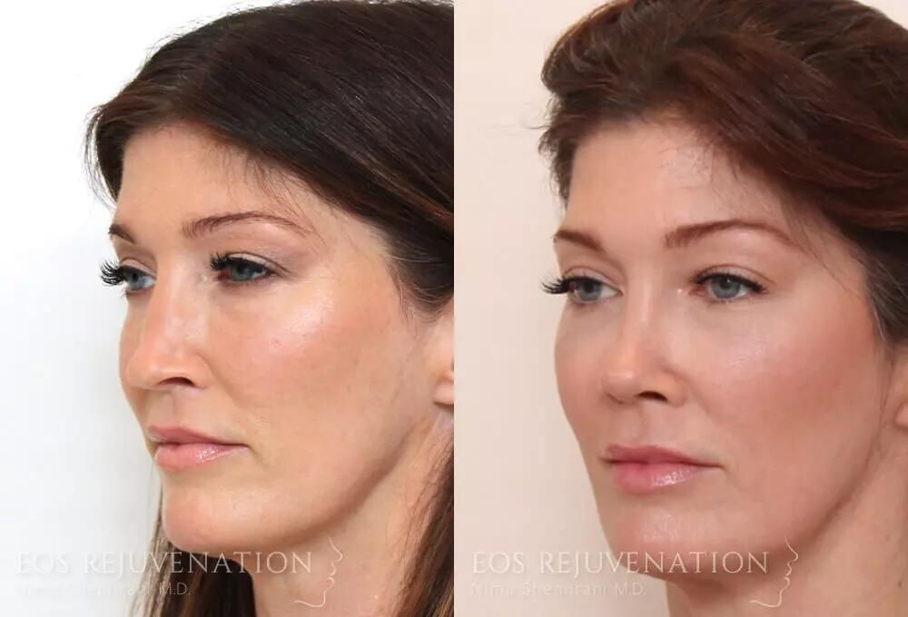 Rhinoplasty Before & After