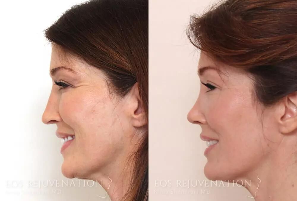 Rhinoplasty Before & After