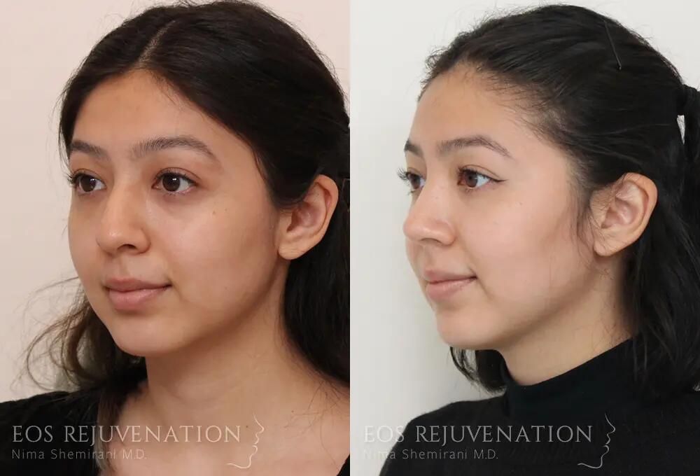 Rhinoplasty Before & After