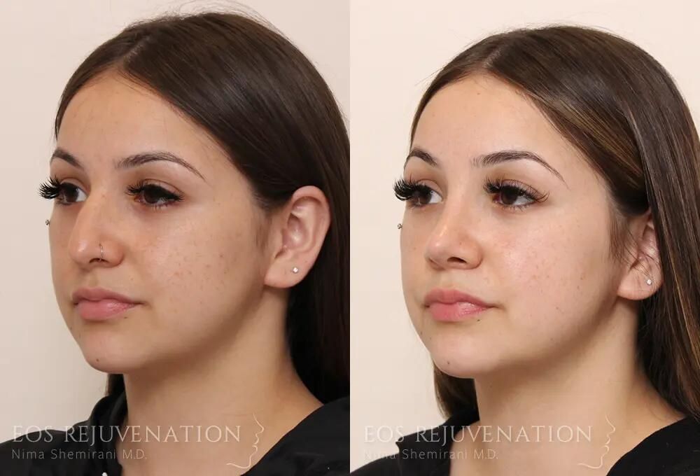Rhinoplasty Before & After