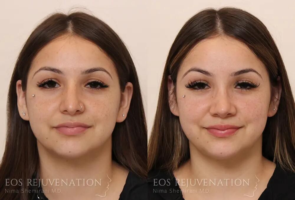 Rhinoplasty Before & After