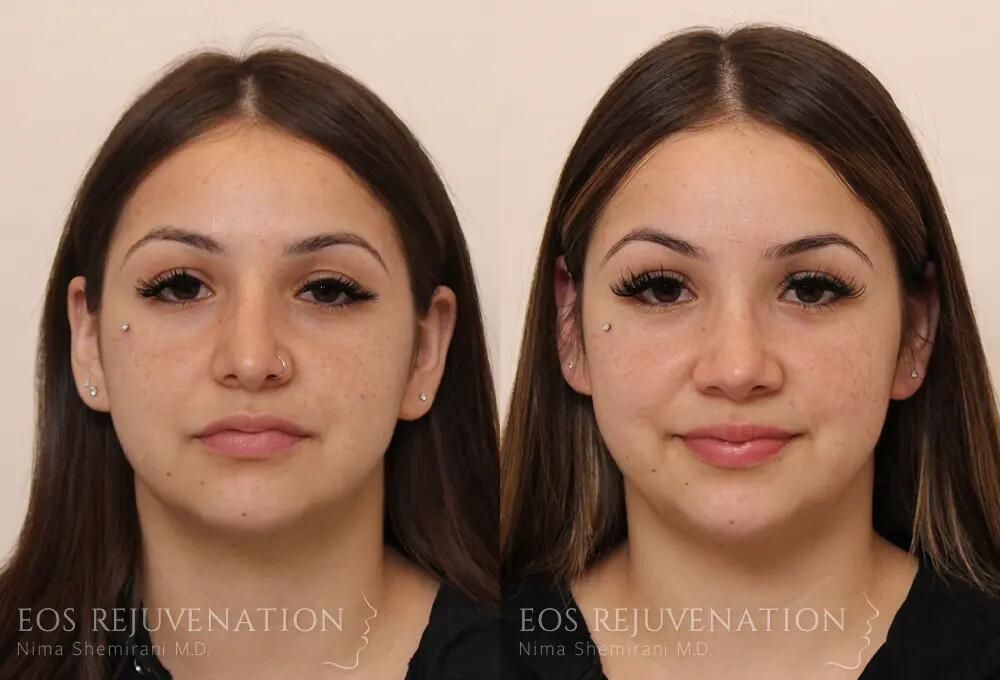 Rhinoplasty Before & After