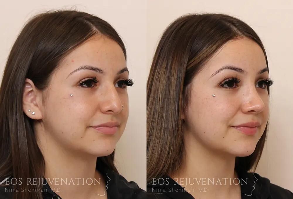 Rhinoplasty Before & After