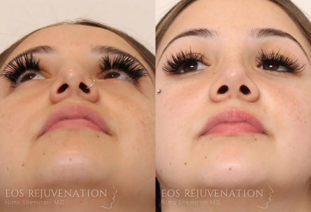 Rhinoplasty Before & After
