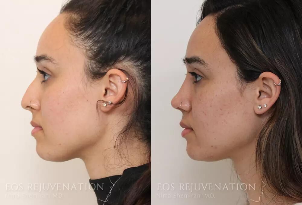 Rhinoplasty Before & After