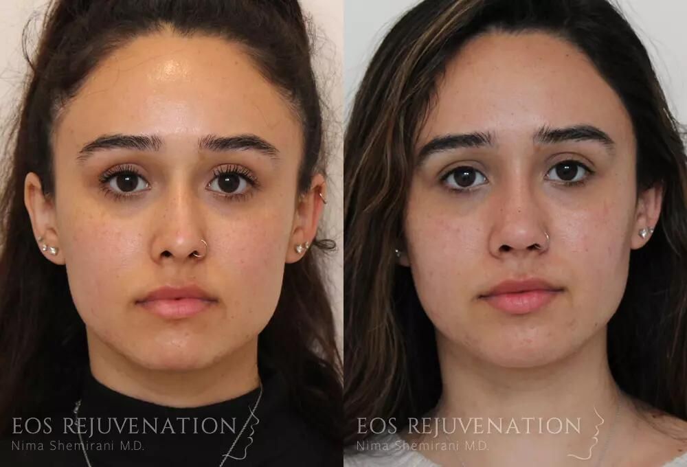 Rhinoplasty Before & After