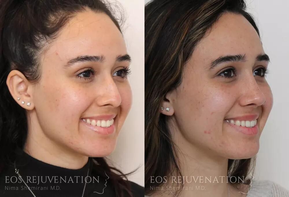 Rhinoplasty Before & After