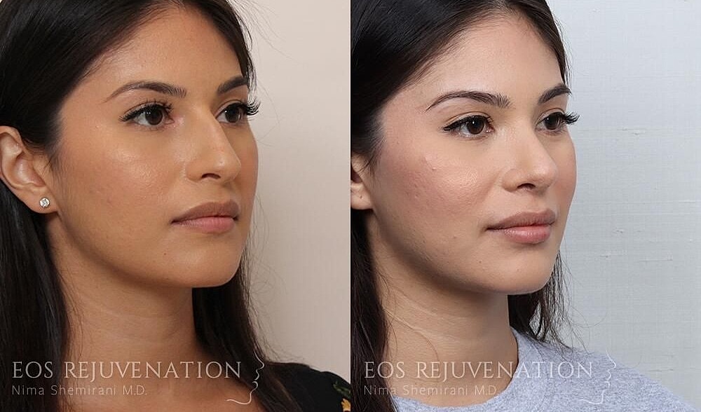 Rhinoplasty Before & After