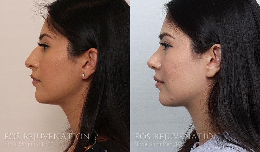 Rhinoplasty Before & After