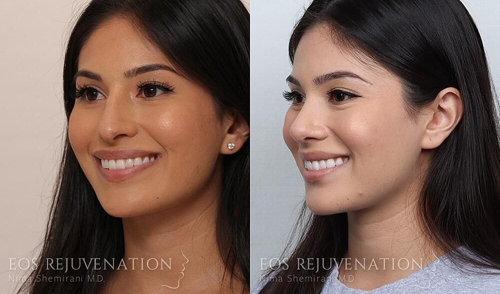 Rhinoplasty Before & After