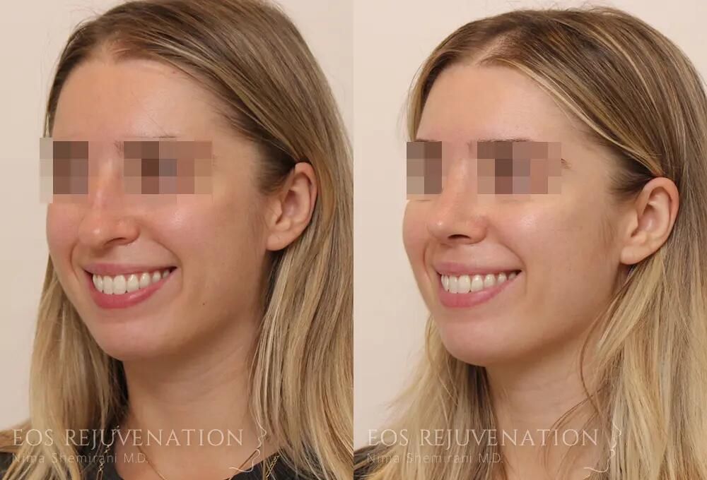 Rhinoplasty Before & After