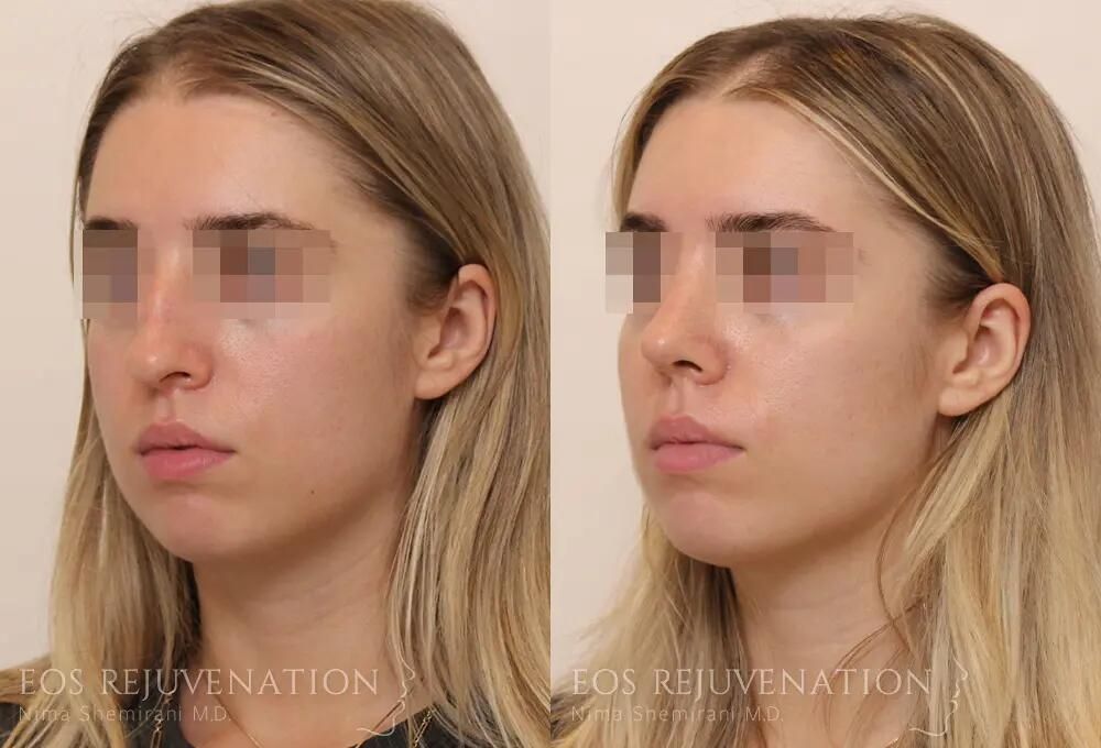 Rhinoplasty Before & After