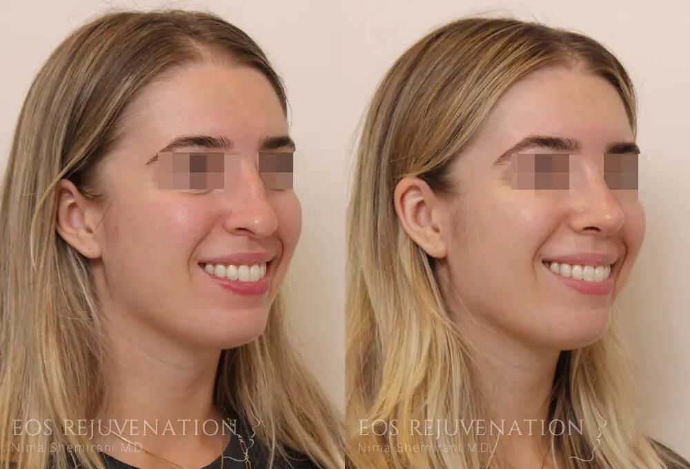 Rhinoplasty Before & After