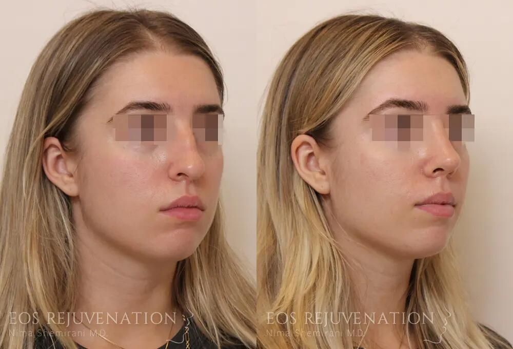 Rhinoplasty Before & After