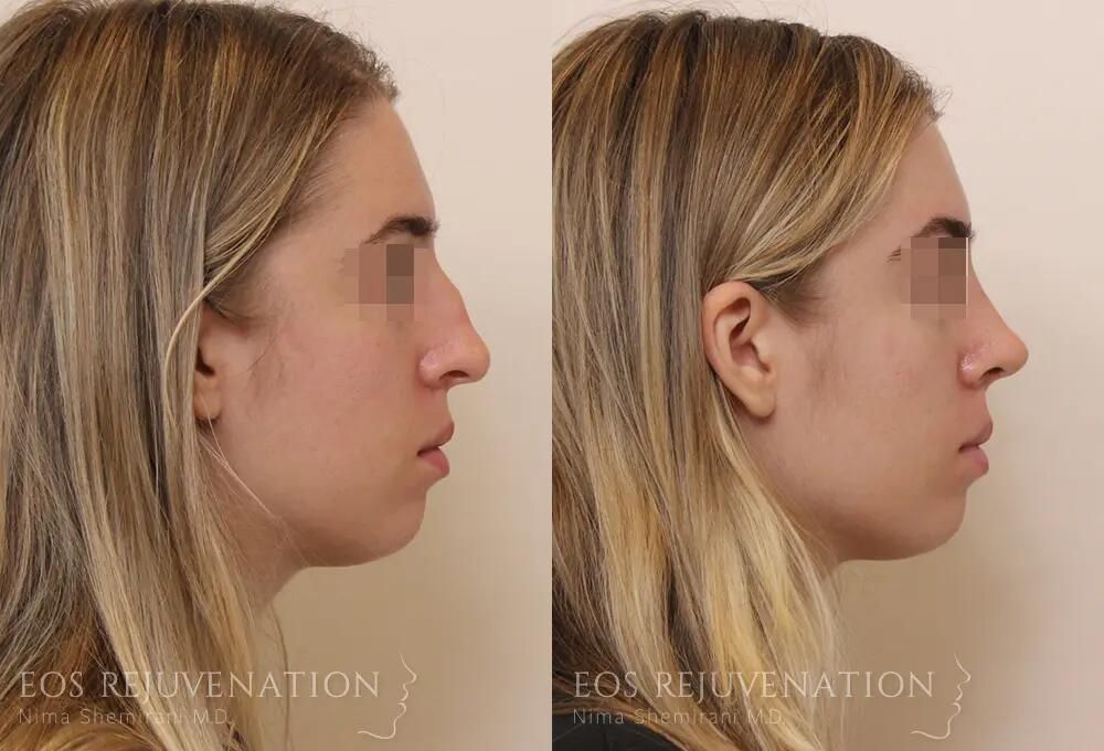 Rhinoplasty Before & After