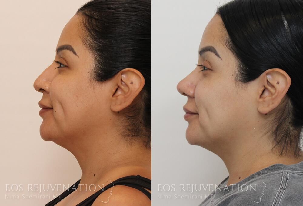 Rhinoplasty Before & After
