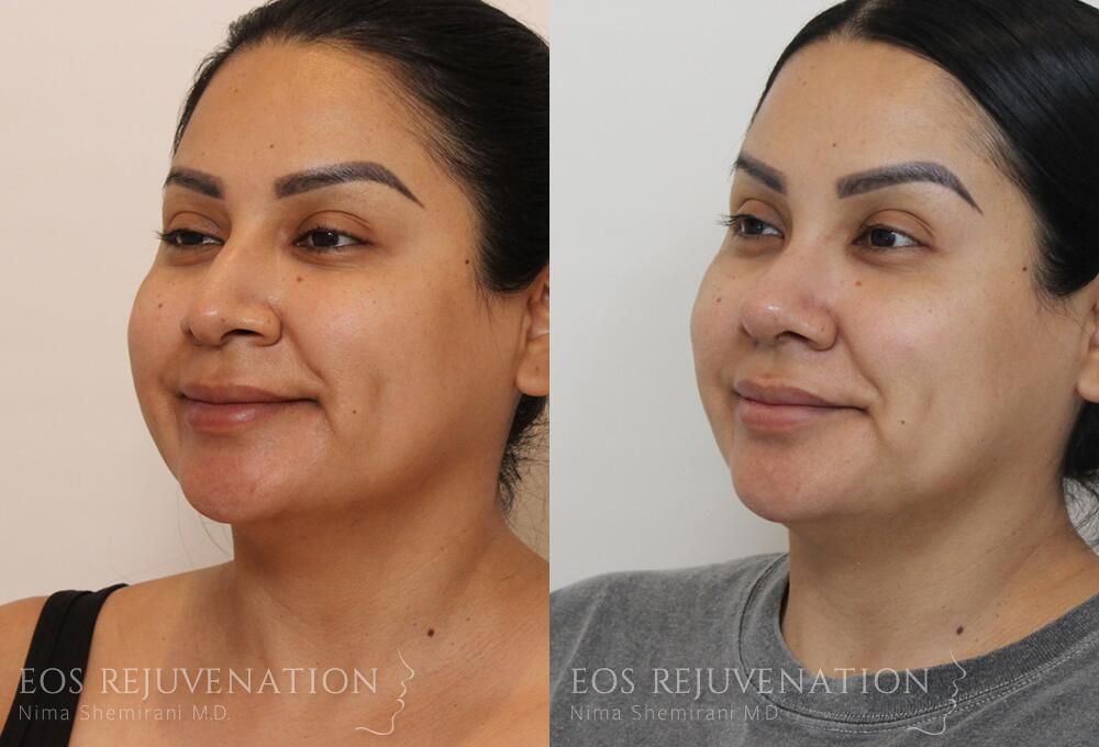 Rhinoplasty Before & After