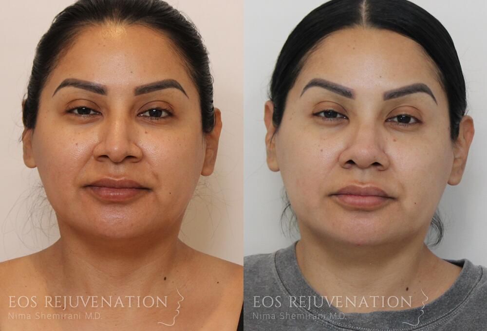 Rhinoplasty Before & After