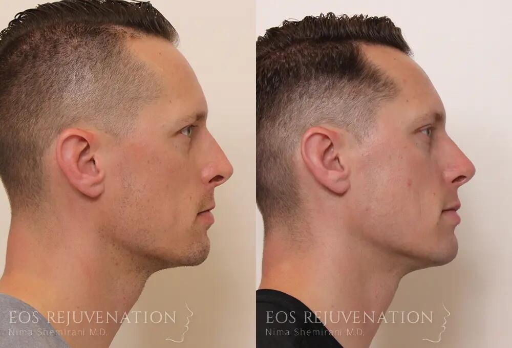 Rhinoplasty Before & After