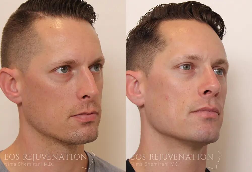 Rhinoplasty Before & After