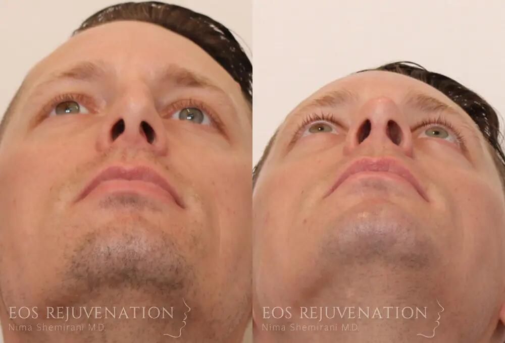 Rhinoplasty Before & After