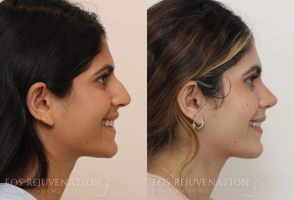 Rhinoplasty Before & After