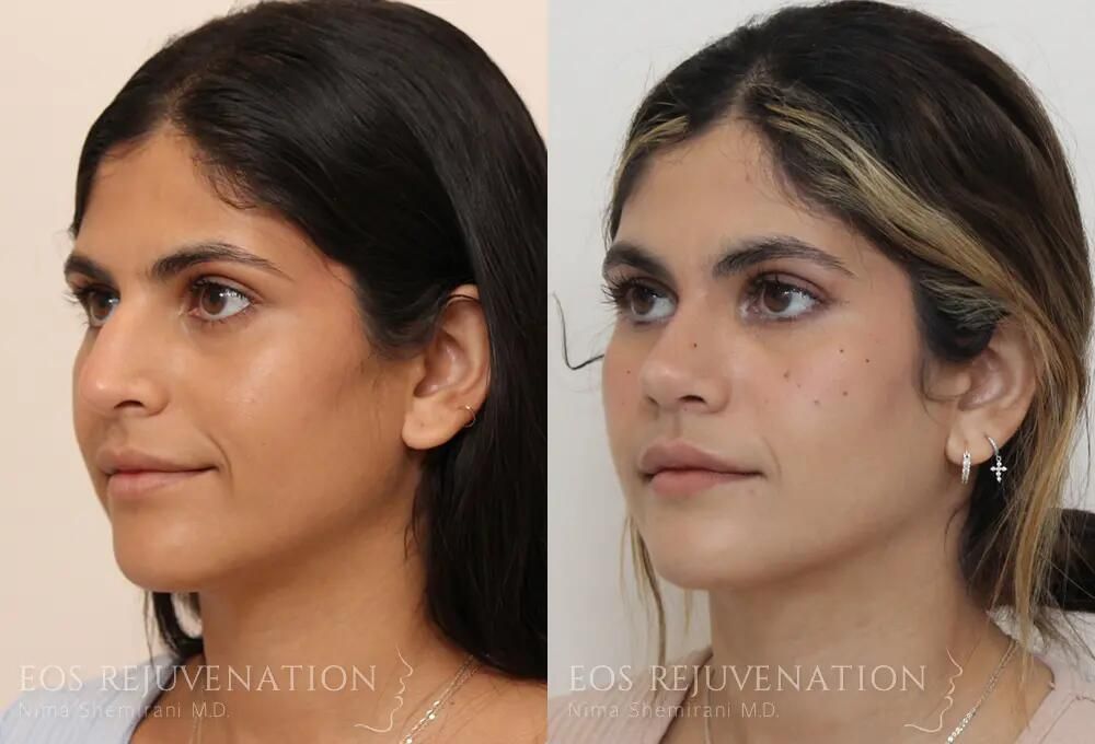 Rhinoplasty Before & After