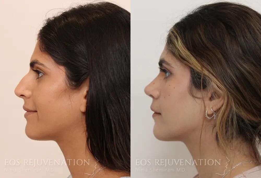 Rhinoplasty Before & After
