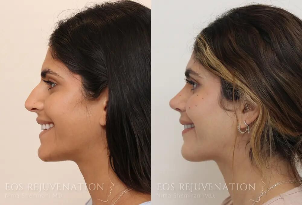 Rhinoplasty Before & After