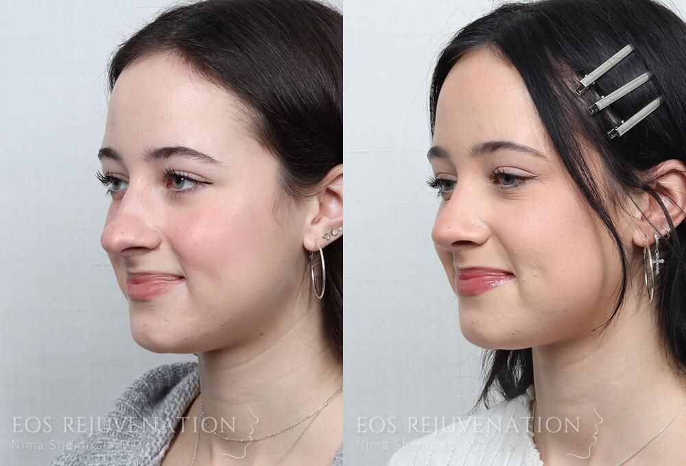 Rhinoplasty Before & After