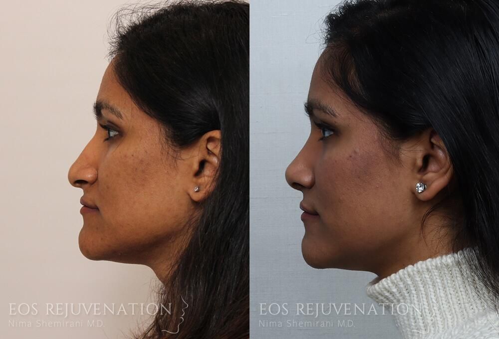 Rhinoplasty Before & After